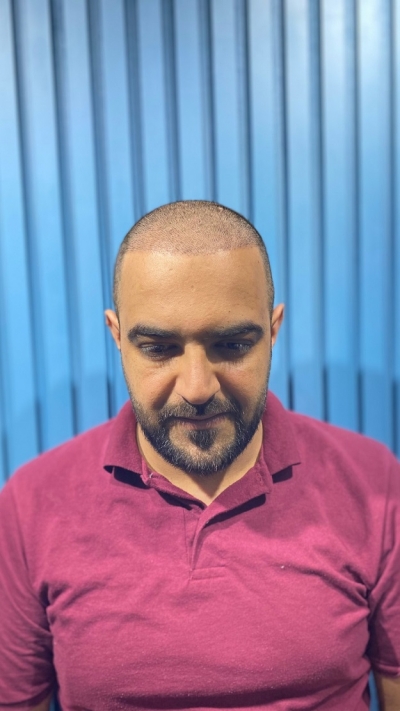 KANADA’DAN SAÇ EKİMİ İÇİN ESTERİSE’I TERCİH ETTİ