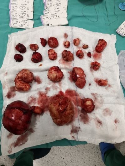 RAHMİNDEN 25 ADET TÜMÖR ÇIKARTILDI